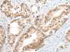 Immunohistochemistry of paraffin-embedded Human colorectal cancer tissue  using ZNF83 Polyclonal Antibody at dilution of 1:50(×200)