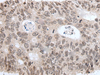 Immunohistochemistry of paraffin-embedded Human colorectal cancer tissue  using HIST1H3A Polyclonal Antibody at dilution of 1:35(×200)