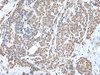 Immunohistochemistry of paraffin-embedded Human thyroid cancer tissue  using WTAP Polyclonal Antibody at dilution of 1:35(×200)