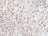 Immunohistochemistry of paraffin-embedded Human esophagus cancer tissue  using VRK1 Polyclonal Antibody at dilution of 1:30(×200)