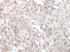 Immunohistochemistry of paraffin-embedded Human lung cancer tissue  using VRK3 Polyclonal Antibody at dilution of 1:45(×200)