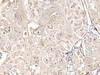 Immunohistochemistry of paraffin-embedded Human esophagus cancer tissue  using VRK3 Polyclonal Antibody at dilution of 1:45(×200)
