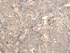 Immunohistochemistry of paraffin-embedded Human liver cancer tissue  using VTI1B Polyclonal Antibody at dilution of 1:30(×200)