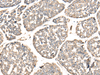 Immunohistochemistry of paraffin-embedded Human esophagus cancer tissue  using VTI1B Polyclonal Antibody at dilution of 1:30(×200)