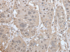Immunohistochemistry of paraffin-embedded Human esophagus cancer tissue  using UBASH3A Polyclonal Antibody at dilution of 1:50(×200)