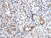 Immunohistochemistry of paraffin-embedded Human cervical cancer tissue  using UBE2W Polyclonal Antibody at dilution of 1:55(×200)