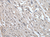 Immunohistochemistry of paraffin-embedded Human esophagus cancer tissue  using UBE2W Polyclonal Antibody at dilution of 1:55(×200)