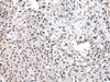 Immunohistochemistry of paraffin-embedded Human lung cancer tissue  using UBE2E3 Polyclonal Antibody at dilution of 1:40(×200)