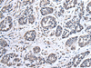 Immunohistochemistry of paraffin-embedded Human esophagus cancer tissue  using UBE2E3 Polyclonal Antibody at dilution of 1:40(×200)