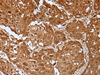 Immunohistochemistry of paraffin-embedded Human esophagus cancer tissue  using UBA7 Polyclonal Antibody at dilution of 1:35(×200)
