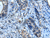 Immunohistochemistry of paraffin-embedded Human cervical cancer tissue  using UFC1 Polyclonal Antibody at dilution of 1:50(×200)