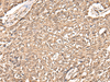 Immunohistochemistry of paraffin-embedded Human lung cancer tissue  using USP21 Polyclonal Antibody at dilution of 1:50(×200)