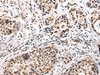 Immunohistochemistry of paraffin-embedded Human cervical cancer tissue  using USP6NL Polyclonal Antibody at dilution of 1:30(×200)