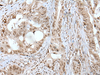 Immunohistochemistry of paraffin-embedded Human colorectal cancer tissue  using USP3 Polyclonal Antibody at dilution of 1:50(×200)