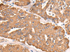 Immunohistochemistry of paraffin-embedded Human liver cancer tissue  using ATP5C1 Polyclonal Antibody at dilution of 1:55(×200)
