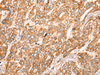 Immunohistochemistry of paraffin-embedded Human liver cancer tissue  using ZMYND10 Polyclonal Antibody at dilution of 1:35(×200)