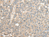 Immunohistochemistry of paraffin-embedded Human liver cancer tissue  using CASQ1 Polyclonal Antibody at dilution of 1:100(×200)