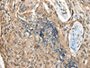 Immunohistochemistry of paraffin-embedded Human esophagus cancer tissue  using CAMKK1 Polyclonal Antibody at dilution of 1:35(×200)