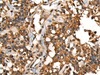 Immunohistochemistry of paraffin-embedded Human ovarian cancer tissue  using SHPK Polyclonal Antibody at dilution of 1:45(×200)