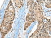 Immunohistochemistry of paraffin-embedded Human esophagus cancer tissue  using CASK Polyclonal Antibody at dilution of 1:65(×200)