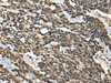 Immunohistochemistry of paraffin-embedded Human lung cancer tissue  using MICU1 Polyclonal Antibody at dilution of 1:35(×200)
