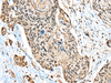 Immunohistochemistry of paraffin-embedded Human esophagus cancer tissue  using CBFB Polyclonal Antibody at dilution of 1:40(×200)