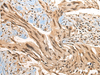 Immunohistochemistry of paraffin-embedded Human breast cancer tissue  using CBFB Polyclonal Antibody at dilution of 1:40(×200)