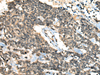 Immunohistochemistry of paraffin-embedded Human lung cancer tissue  using CCNB1IP1 Polyclonal Antibody at dilution of 1:30(×200)