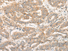 Immunohistochemistry of paraffin-embedded Human liver cancer tissue  using CPNE4 Polyclonal Antibody at dilution of 1:40(×200)