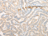 Immunohistochemistry of paraffin-embedded Human thyroid cancer tissue  using CELA3A Polyclonal Antibody at dilution of 1:25(×200)