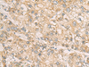 Immunohistochemistry of paraffin-embedded Human liver cancer tissue  using STX5 Polyclonal Antibody at dilution of 1:70(×200)