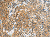 Immunohistochemistry of paraffin-embedded Human cervical cancer tissue  using TUFT1 Polyclonal Antibody at dilution of 1:120(×200)