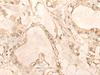 Immunohistochemistry of paraffin-embedded Human gastric cancer tissue  using PLEKHA1 Polyclonal Antibody at dilution of 1:30(×200)