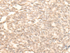 Immunohistochemistry of paraffin-embedded Human lung cancer tissue  using RAD23B Polyclonal Antibody at dilution of 1:25(×200)