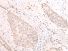 Immunohistochemistry of paraffin-embedded Human esophagus cancer tissue  using TBC1D2 Polyclonal Antibody at dilution of 1:25(×200)