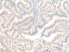 Immunohistochemistry of paraffin-embedded Human thyroid cancer tissue  using AOAH Polyclonal Antibody at dilution of 1:25(×200)