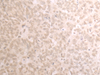 Immunohistochemistry of paraffin-embedded Human ovarian cancer tissue  using TRMT1 Polyclonal Antibody at dilution of 1:25(×200)