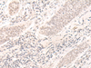 Immunohistochemistry of paraffin-embedded Human esophagus cancer tissue  using ZBED1 Polyclonal Antibody at dilution of 1:40(×200)