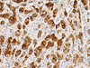 Immunohistochemistry of paraffin-embedded Human liver cancer tissue  using SAA1 Polyclonal Antibody at dilution of 1:70(×200)