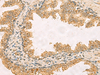 Immunohistochemistry of paraffin-embedded Human prost ate cancer tissue  using RPS11 Polyclonal Antibody at dilution of 1:40(×200)