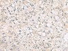 Immunohistochemistry of paraffin-embedded Human liver cancer tissue  using POFUT1 Polyclonal Antibody at dilution of 1:50(×200)