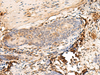 Immunohistochemistry of paraffin-embedded Human esophagus cancer tissue  using HLA-DQB1 Polyclonal Antibody at dilution of 1:30(×200)