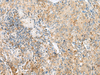 Immunohistochemistry of paraffin-embedded Human cervical cancer tissue  using CNPY3 Polyclonal Antibody at dilution of 1:55(×200)