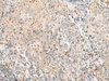 Immunohistochemistry of paraffin-embedded Human cervical cancer tissue  using EIF3L Polyclonal Antibody at dilution of 1:55(×200)