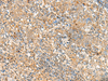 Immunohistochemistry of paraffin-embedded Human cervical cancer tissue  using FKBP1A Polyclonal Antibody at dilution of 1:55(×200)