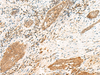 Immunohistochemistry of paraffin-embedded Human esophagus cancer tissue  using POLR1D Polyclonal Antibody at dilution of 1:50(×200)