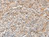 Immunohistochemistry of paraffin-embedded Human cervical cancer tissue  using H3F3B Polyclonal Antibody at dilution of 1:40(×200)