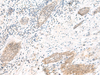 Immunohistochemistry of paraffin-embedded Human esophagus cancer tissue  using ARL2BP Polyclonal Antibody at dilution of 1:50(×200)