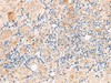 Immunohistochemistry of paraffin-embedded Human liver cancer tissue  using THNSL1 Polyclonal Antibody at dilution of 1:70(×200)