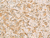 Immunohistochemistry of paraffin-embedded Human liver cancer tissue  using MRPS35 Polyclonal Antibody at dilution of 1:60(×200)